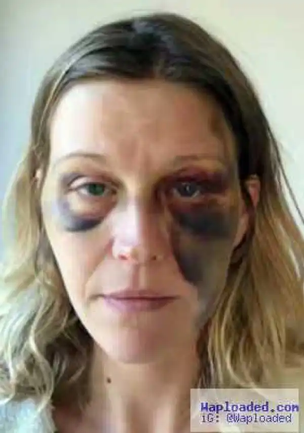 New Mum Shows Off Domestic Violence Scars Inflicted By Partner Few Weeks After Birthing Her Child